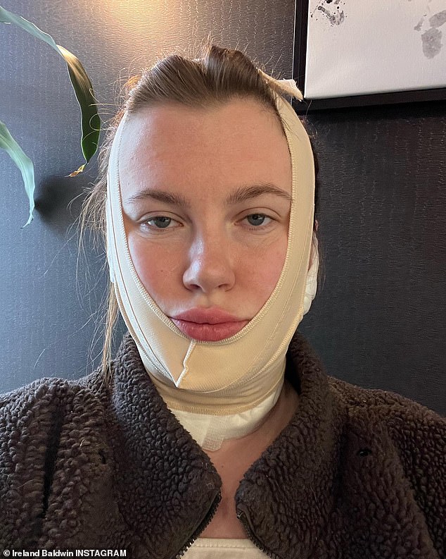 A gyógyulás: A 26 éves modell egy kedden délután közzétett új Instagram-videóban kifejtette, hogy a FaceTite egy minimálisan invazív, órákig tartó irodai eljárás, amelyhez még érzéstelenítés sem szükséges.